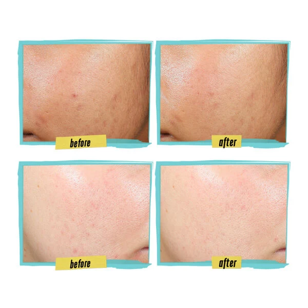 Kiehl’s - Expertly Clear Blemish-Treating & Preventing Lotion