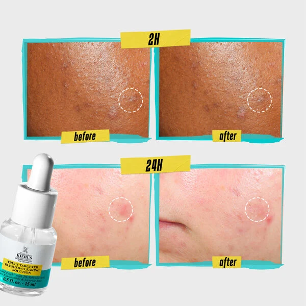 Kiehl’s - Truly Targeted Blemish Clearing Solution