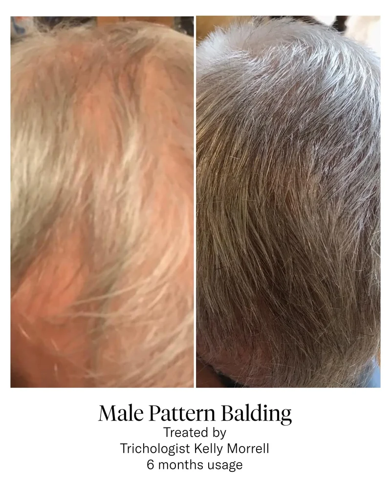 Advanced Hair System Kit